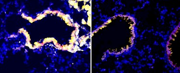 科学家们找到了一种逆转癌症肿瘤免疫抑制的新方法