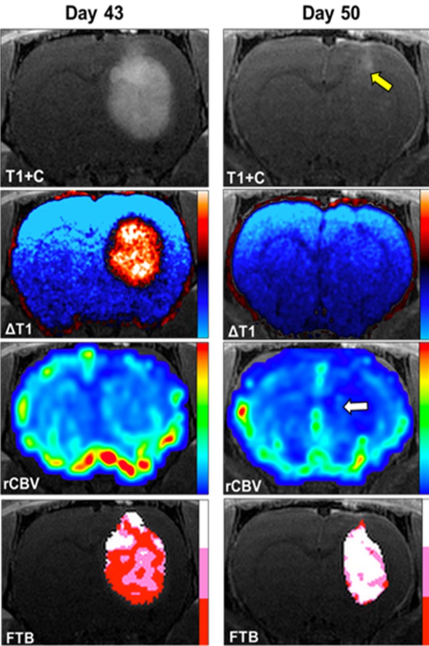 高级 MRI 脑癌 肿瘤